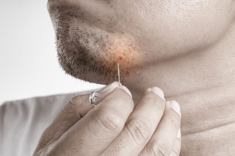 Man treating ingrown hair