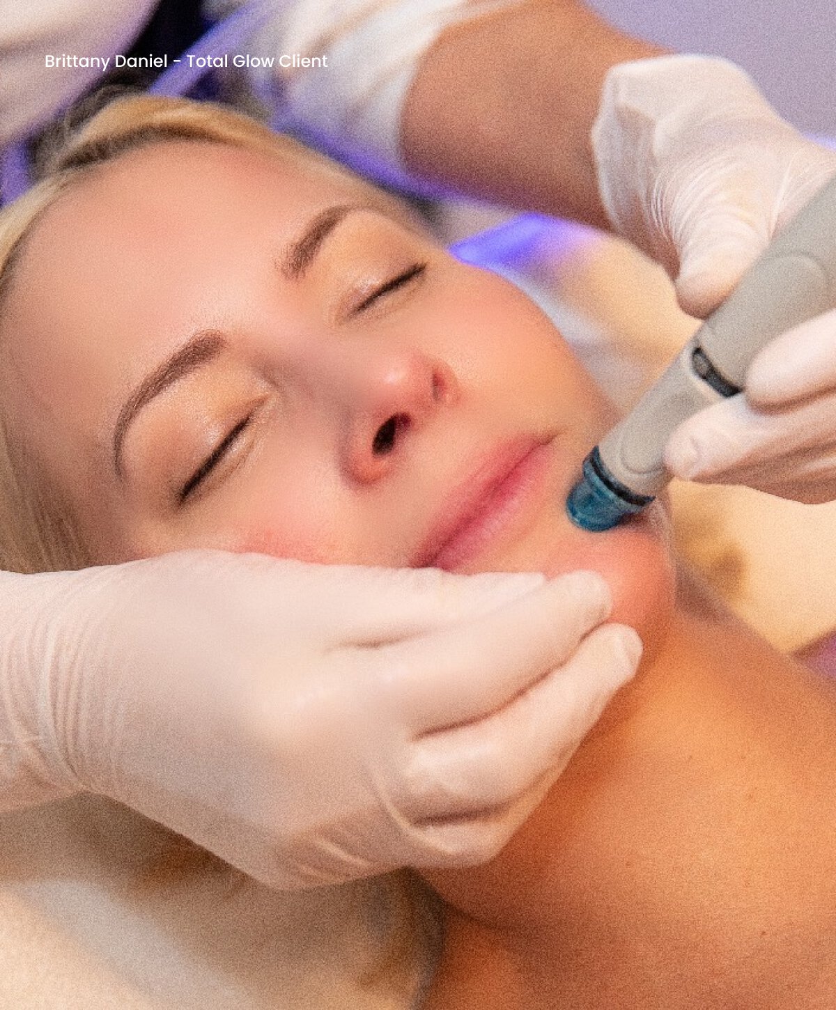 Bay Area HydraFacial model with perfect skin