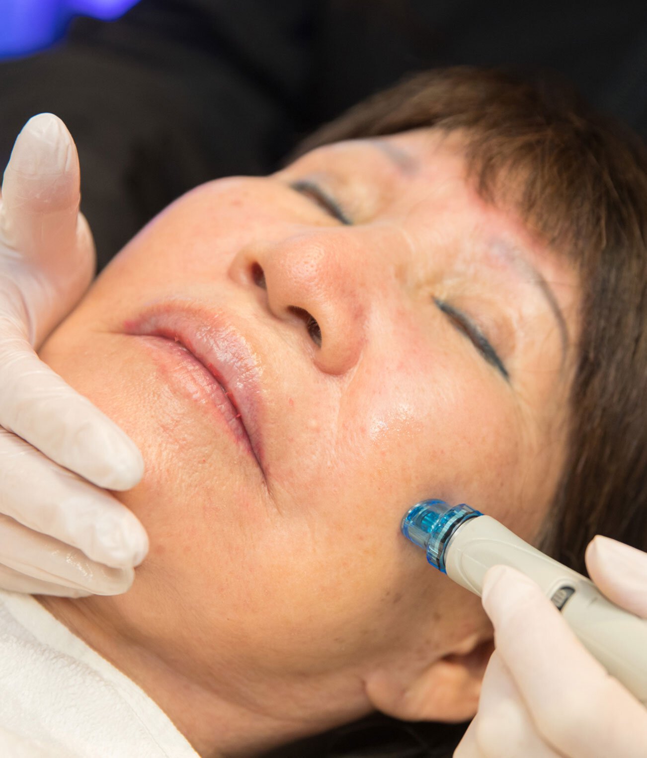 Palo Alto HydraFacial treatment